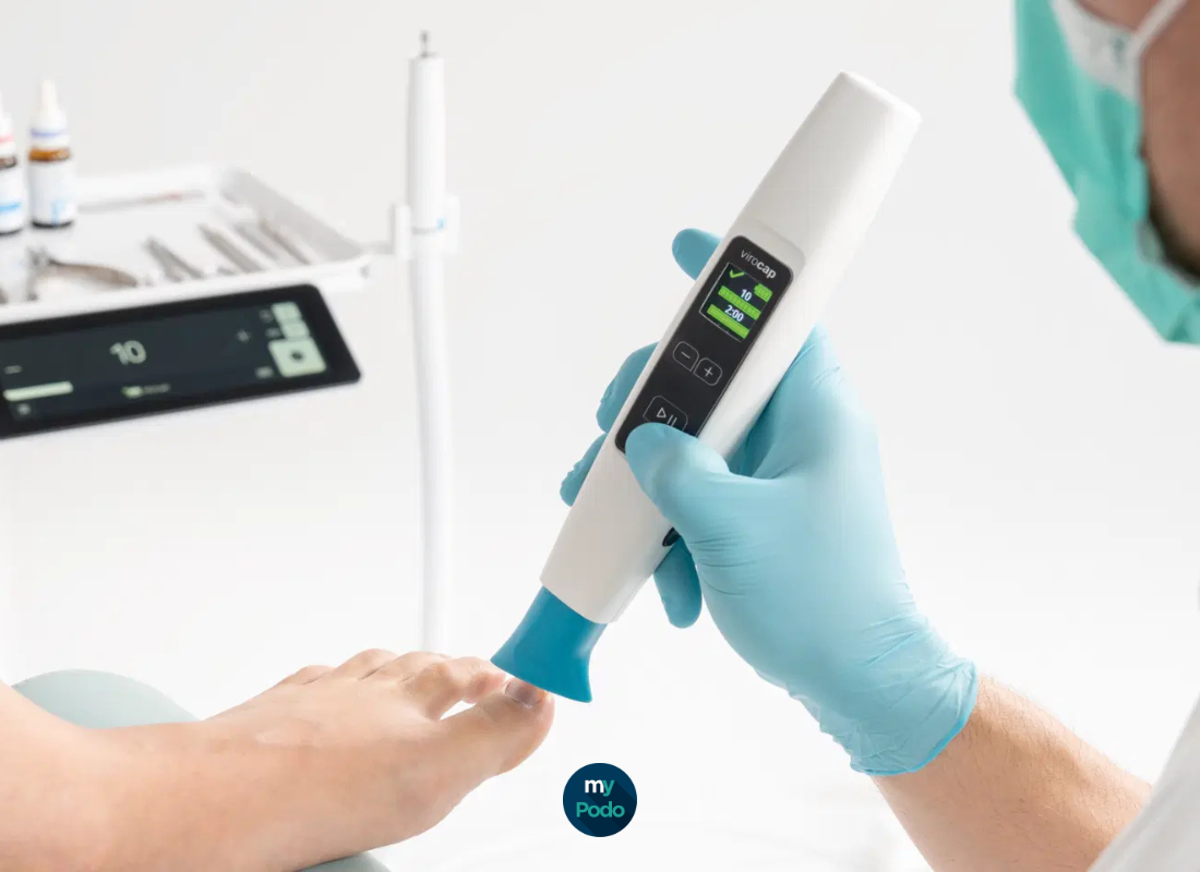 Protocole d'utilisation du ViroCap Ruck : traiter les mycoses au plasma froid
